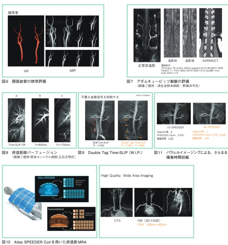 図 10　AtlasSPEEDERCoil を用いた非造影 MRA